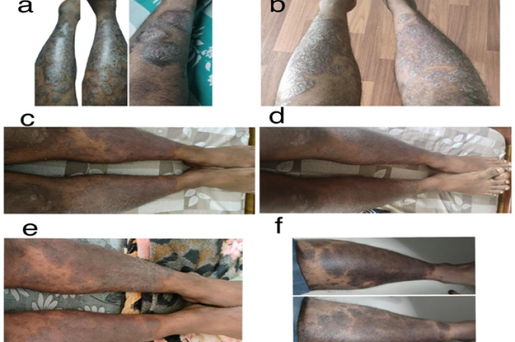 Shows the physical examination of the patient, (a) before secukinumab treatment, (b) after 0h dose, (c) after 1" dose, (d) after 2nd dose, (e) after 3d dose and, (f) after 4 dose.