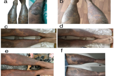 Shows the physical examination of the patient, (a) before secukinumab treatment, (b) after 0h dose, (c) after 1" dose, (d) after 2nd dose, (e) after 3d dose and, (f) after 4 dose.
